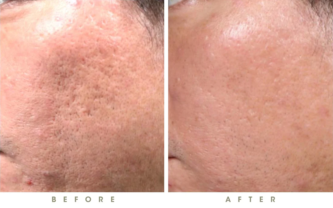 How to Get Glowing Summer Skin in Raleigh - synergy microneedling results before and after picture