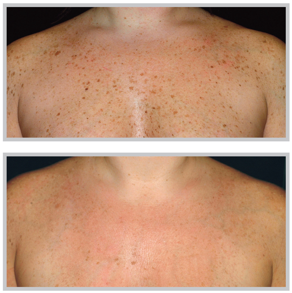 bbl before and after for how to treat sun damage in raleigh