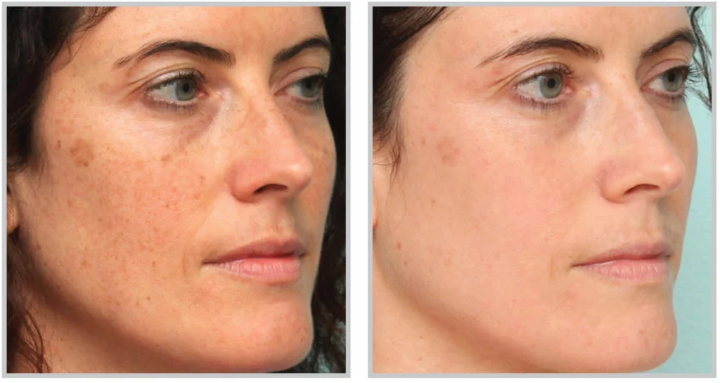 before and after treatment of sun damage in raleigh using nanolaser peel.