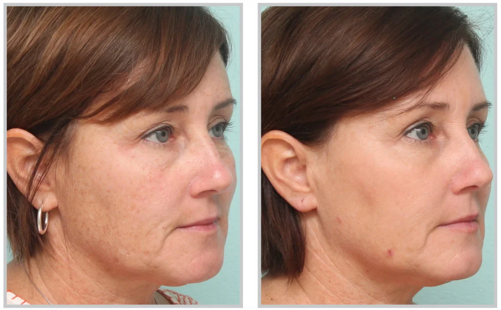 treating sun damage in raleigh using a microlaser peel - before and afters from synergy med spa