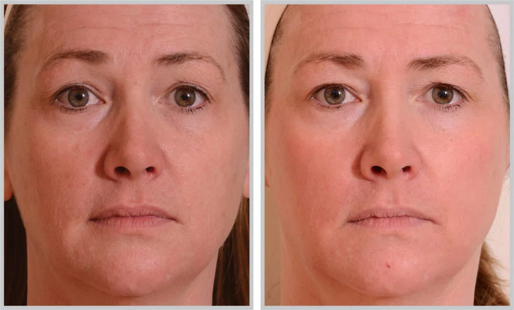 laser resurfacing in raleigh - before and after 3