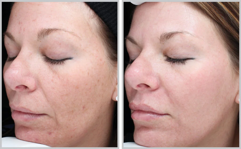 before and after photo - how to treat sun damage in raleigh using the halo laser
