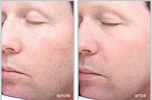 laser resurfacing in raleigh - before and after 2