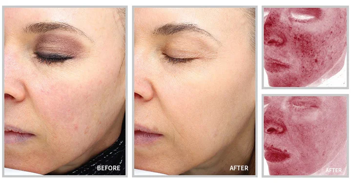 laser resurfacing in raleigh - before and after 1