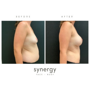 breast augmentation, liposuction
