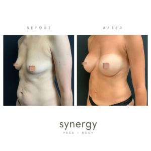 breast augmentation, tummy tuck, mommy makeover