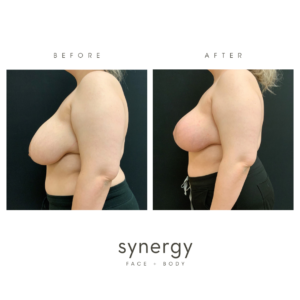 breast augmentation, reduction, breast reduction