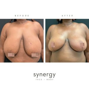 Breast Reduction + Lift by Dr. Hughes in Raleigh, NC