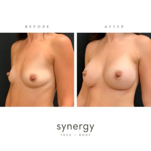 breast augmentation, breast lift, breast exchange