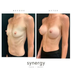 Breast Augmentation/Implants with Dr. Hughes in Raleigh, NC