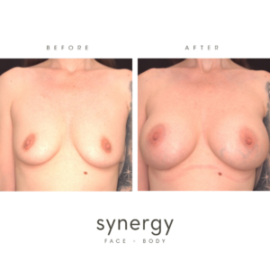 Breast Augmentation/Impanys with Dr. Hughes in Raleigh, NC