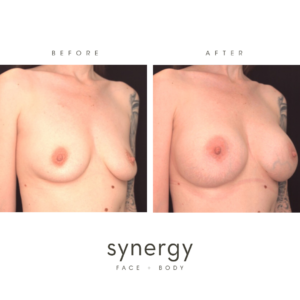 Breast Augmentation/Implants with Dr. Hughes in Raleigh, NC