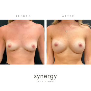 Breast Augmentation/Implants by Dr. Hughes in Raleigh, NC