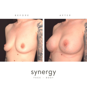 Breast Augmentation/Implants with Dr. Hughes in Raleigh, NC