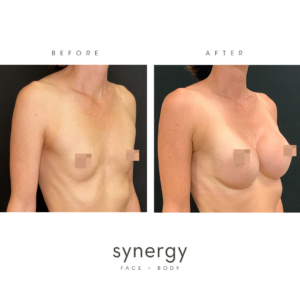 Breast Augmentation/Implants by Dr. Hughes in Raleigh, NC