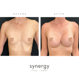 Breast Augmentation/Implants by Dr. Hughes in Raleigh, NC