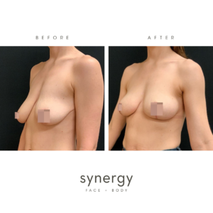 Breast Lift by Dr. Hughes in Raleigh, NC