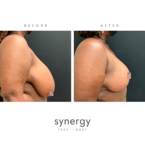 Breast Reduction + Lift by Dr. Hughes in Raleigh, NC
