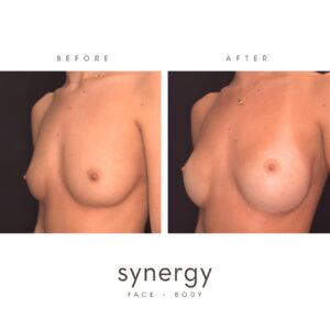Breast Augmentation/Implants by Dr. Hughes in Raleigh, NC
