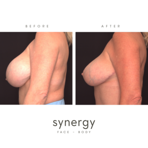 Breast Reduction with Dr. Hughes in Raleigh, NC