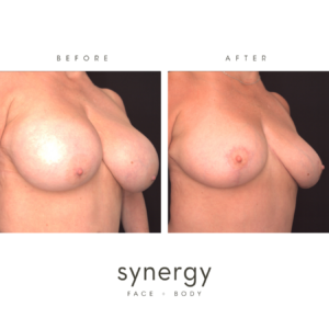 Breast Reduction with Dr. Hughes in Raleigh, NC