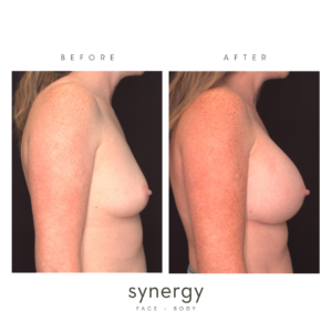 breast augmentation in raleigh, nc