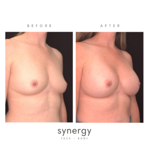 breast augmentation in raleigh, nc
