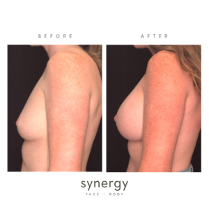 breast augmentation in raleigh, nc