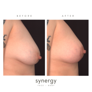 natural breast lift in raleigh nc