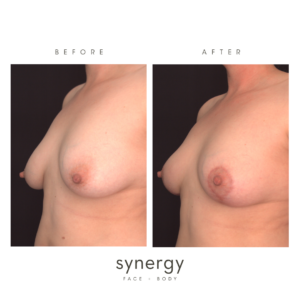 natural breast lift in raleigh nc